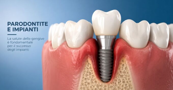 impianti dentali e parodontite