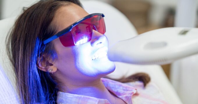 sbiancamento denti